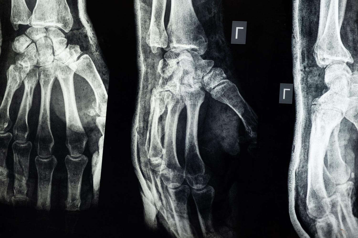 X-ray of spine